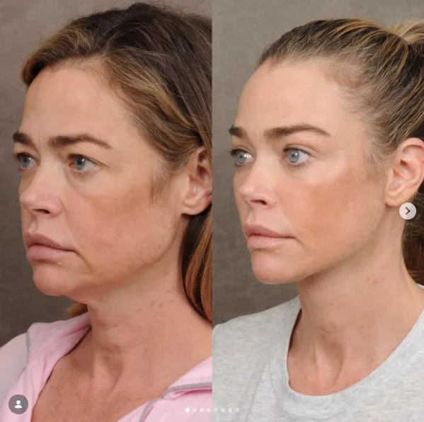 The first comparison presents an extensive transformation without erasing Richards' identity. Her doctor emphasized that the operation was meant to preserve her defining features.