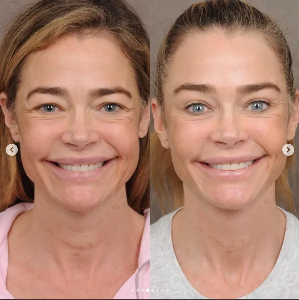 Richards wanted to retain expressions that had been familiar throughout her career. Talei said the internal work helped her smile appear cleaner and more relaxed.