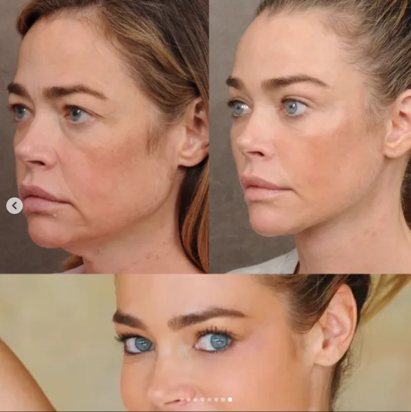 The collage visually links Richards' post-surgery face with the appearance audiences remember from her earlier career. Her stated goal was to recover familiar qualities rather than chase an entirely new identity.