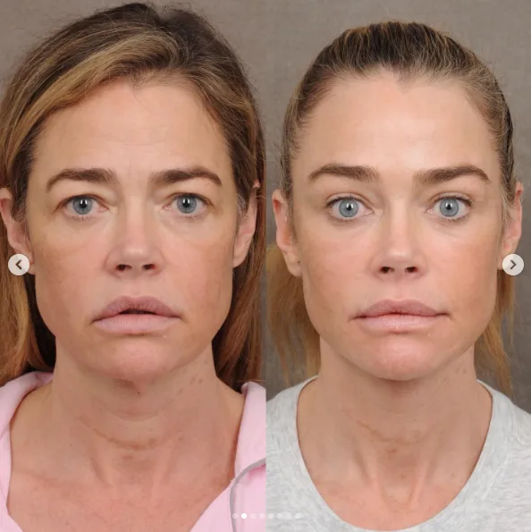The frontal images highlight coordinated changes around the brows, eyes, mouth, jawline, and neck. Richards later called the difference "night and day."