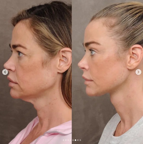 The neck concern that began Richards' surgical journey became part of a broader facial restoration. She later described the decision as one of the best things she had done for herself.