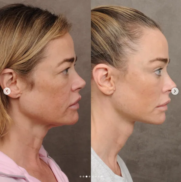 Richards initially wanted to address only her neck. The profile demonstrates why her surgeon believed facial balance required treating more than one isolated area.