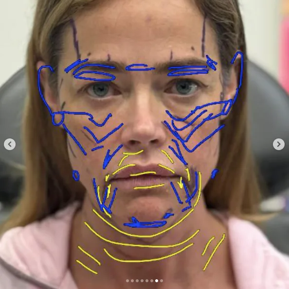 Richards said the markings initially made her think, "Oh my gosh." Seeing the detailed map showed her just how comprehensive the surgery would be.